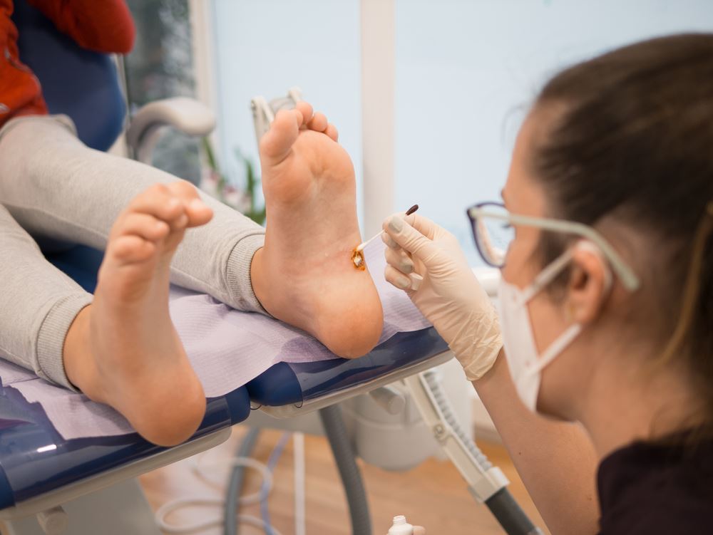 Plantar Warts